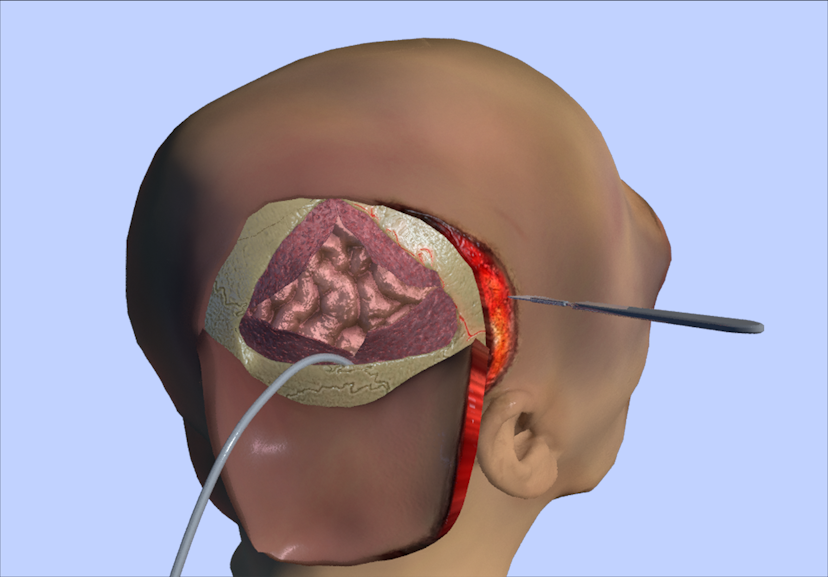 Brain surgery animation